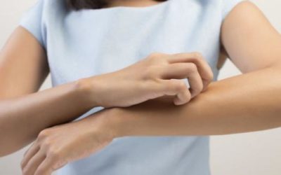 ORTICARIA: UN DISTURBO SEMPRE PIU’ FREQUENTE